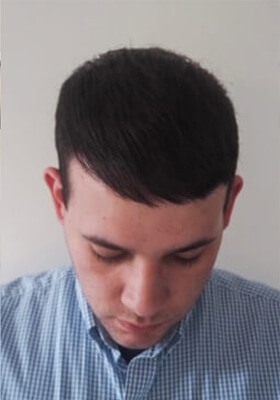 hair transplant before after Photos