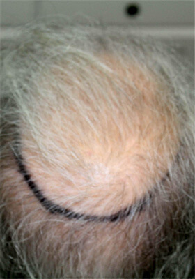 Hair Transplant Patient Photos
