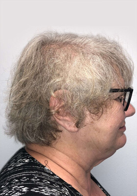 hair transplant before after Photos