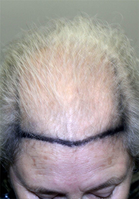 hair transplant before after Photos