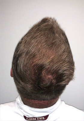 hair transplant before after Photos