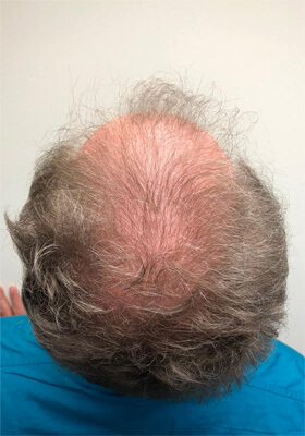 hair transplant before after Photos