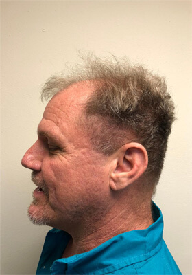 hair transplant before after Photos