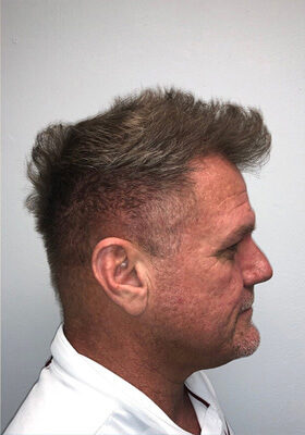 hair transplant before after Photos