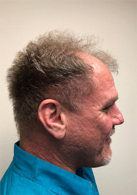 hair transplant before after Photos