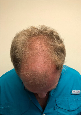 hair transplant before after Photos