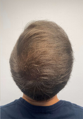 hair transplant before after Photos