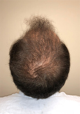 hair transplant before after Photos