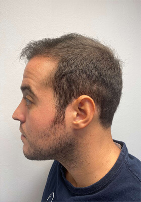 hair transplant before after Photos