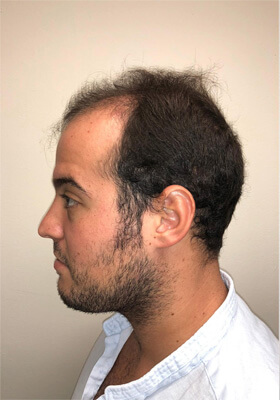 hair transplant before after Photos