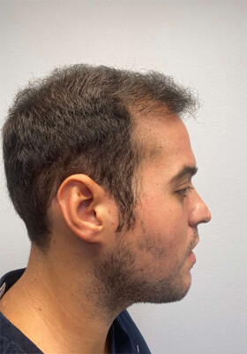 hair transplant before after Photos