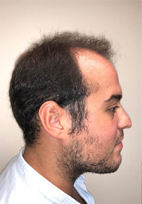 hair transplant before after Photos