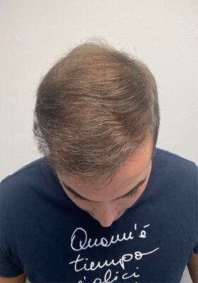 hair transplant before after Photos