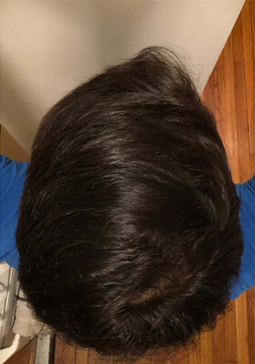 hair transplant before after Photos