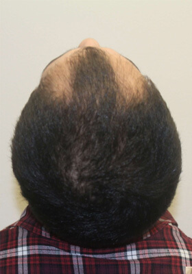 hair transplant before after Photos