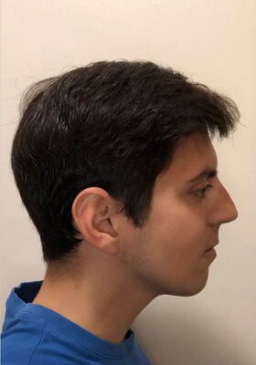 hair transplant before after Photos