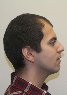 hair transplant before after Photos