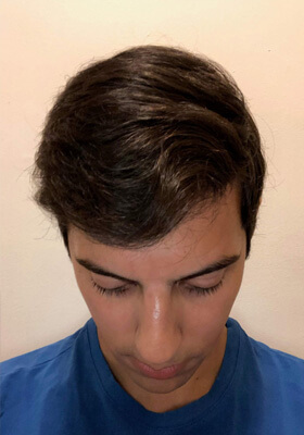 hair transplant before after Photos