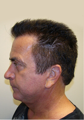 hair transplant before after Photos