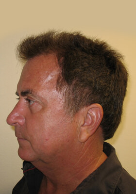 hair transplant photos