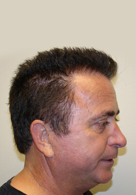 hair transplant photos