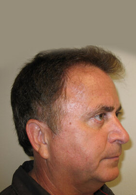 hair transplant photos