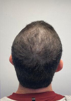 hair transplant before after Photos