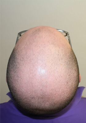 hair transplant before after Photos