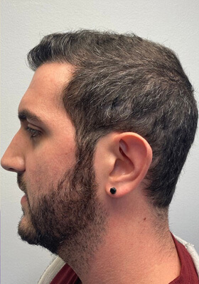 hair transplant before after Photos