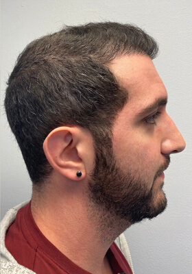 hair transplant before after Photos