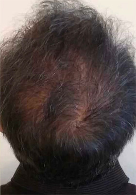 hair transplant before after Photos