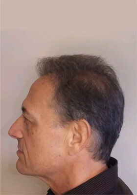 hair transplant before after Photos