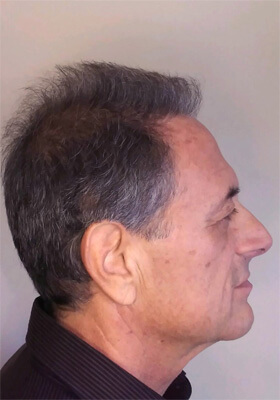 hair transplant before after Photos