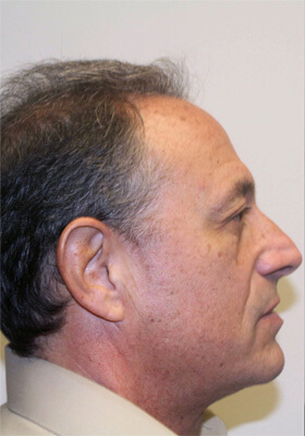 hair transplant before after Photos