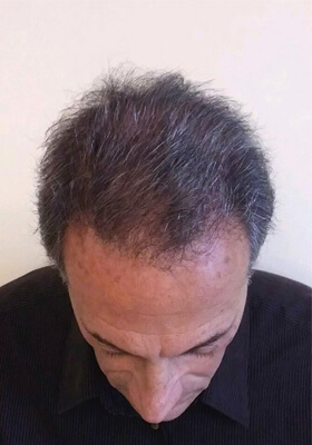 hair transplant before after Photos