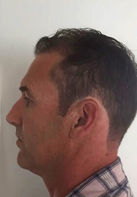 hair transplant before after Photos