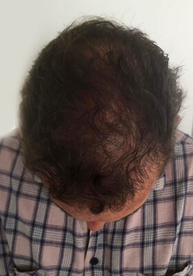 hair transplant before after Photos