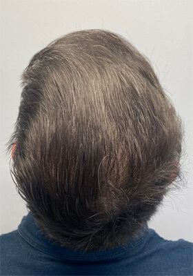 hair transplant before after Photos