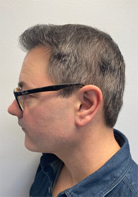 hair transplant photos