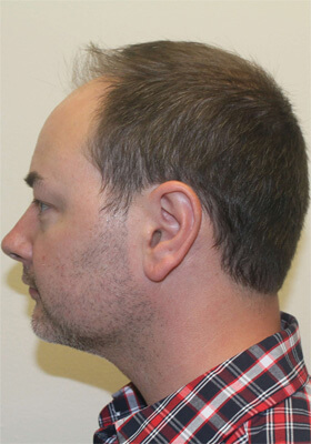 hair transplant photos