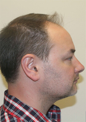 hair transplant before after Photos