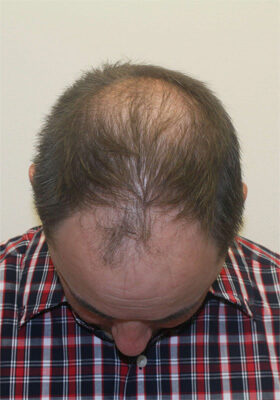 hair transplant before after Photos