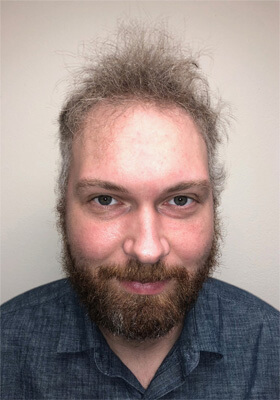 hair transplant photos