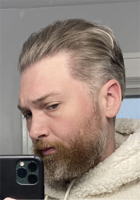hair transplant before after Photos