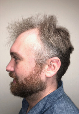 hair transplant photos