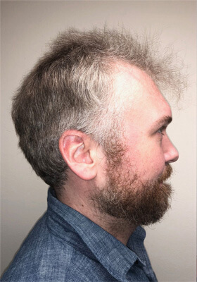 hair transplant photos