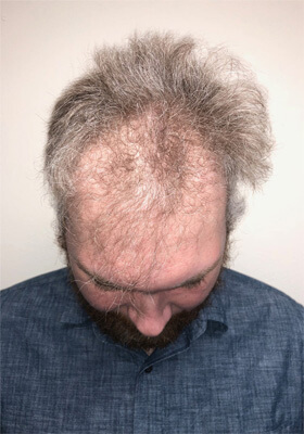 hair transplant photos