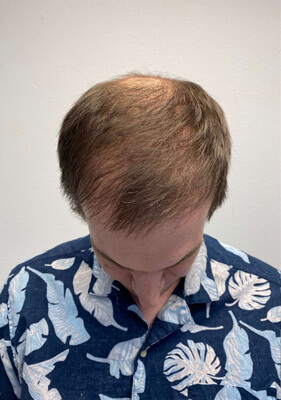 hair transplant before after Photos