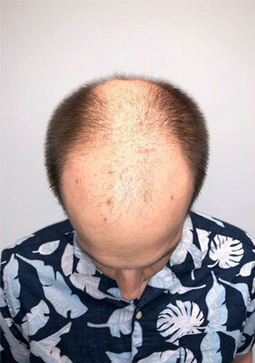hair transplant before after Photos