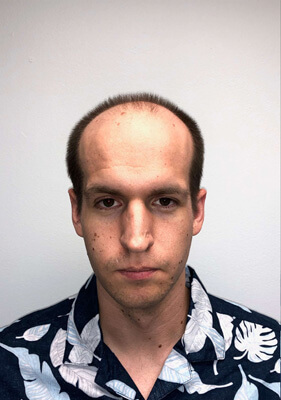 hair transplant photos